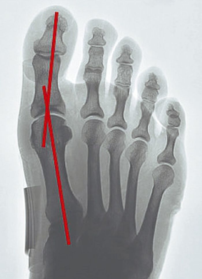 "epitact" Korrekturorthese Hallux-Valgus HAUTFARBEN