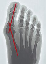 "epitact" Korrekturorthese Hallux-Valgus HAUTFARBEN